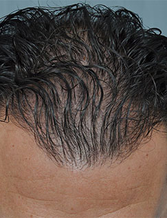 Hair Restoration Baton Rouge